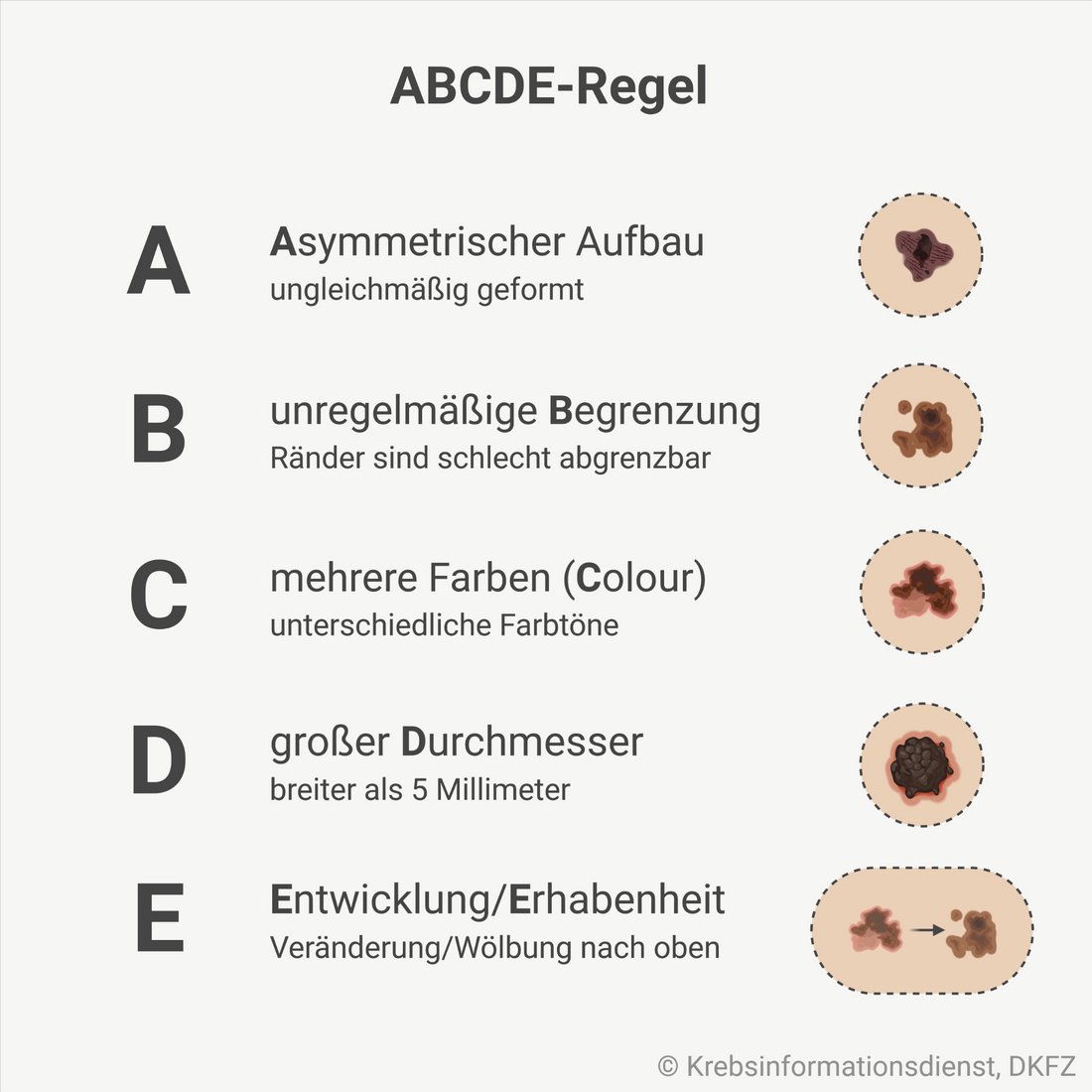 Grafische Darstellung mit den ABCDE-Regeln zur Erkennung für Hautkrebs: A für Asymmetrischer Aufbau, B für unregelmäßige Begrenzung, C für mehrere Farben (Colour), D für großer Durchmesser, E für Entwicklung/Erhabenheit