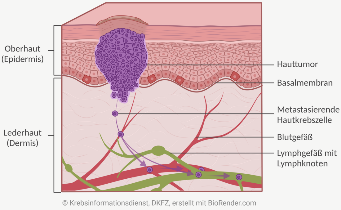 Darstellung wie sich ein Hauttumor von der obersten Hautschicht über das Blut- und Lymphsystem in den Körper ausbreiten kann.