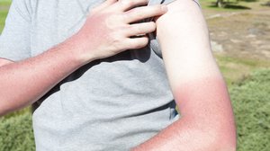 Person mit Sonnenbrand an den Armen, Unterschied zur durch ein T-Shirt geschützten Haut wird aufgezeigt