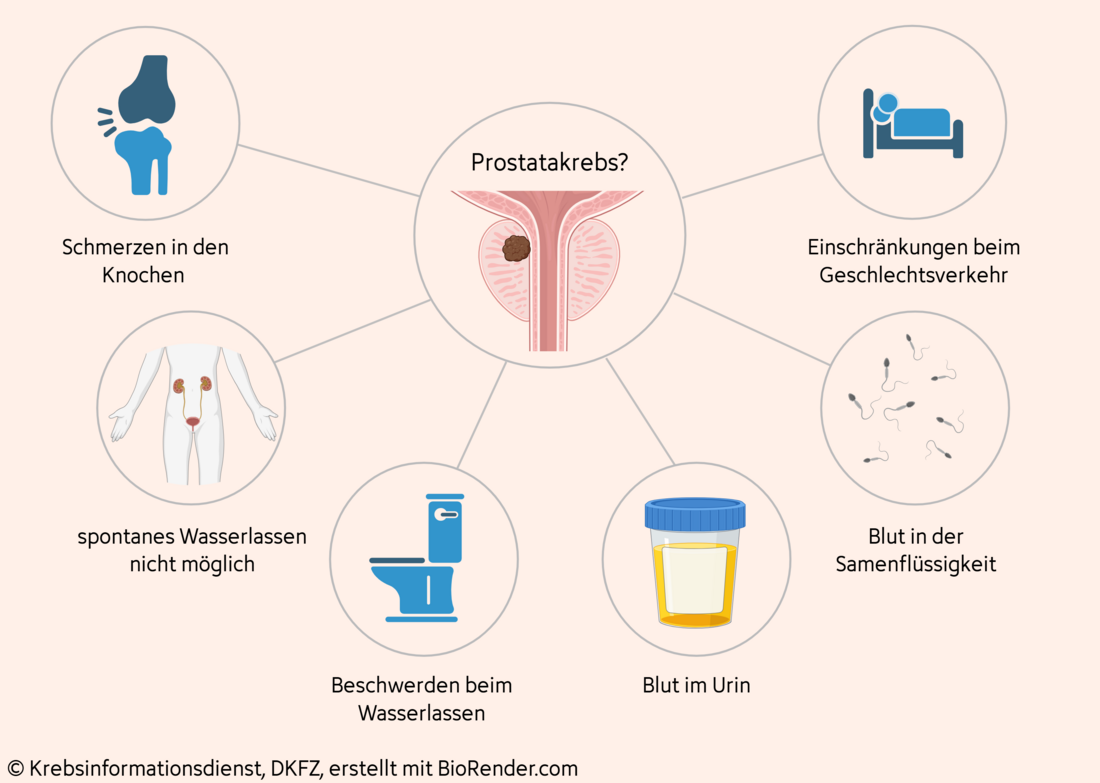Darstellung möglicher Beschwerden bei Prostatakrebs wie zum Beispiel Schmerzen in den Knochen, Einschränkungen beim Geschlechtsverkehr oder auch Blut im Urin oder auch in der Samenflüssigkeit.